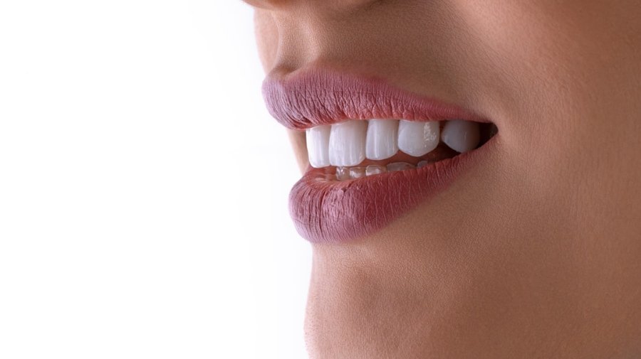 Sorriso transformado com facetas de resina em consultório odontológico em Cascavel PR.