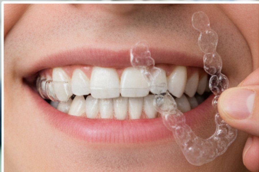 Contenção ortodôntica posicionada sobre modelo de arcada dentária destacando a importância do uso após o aparelho.