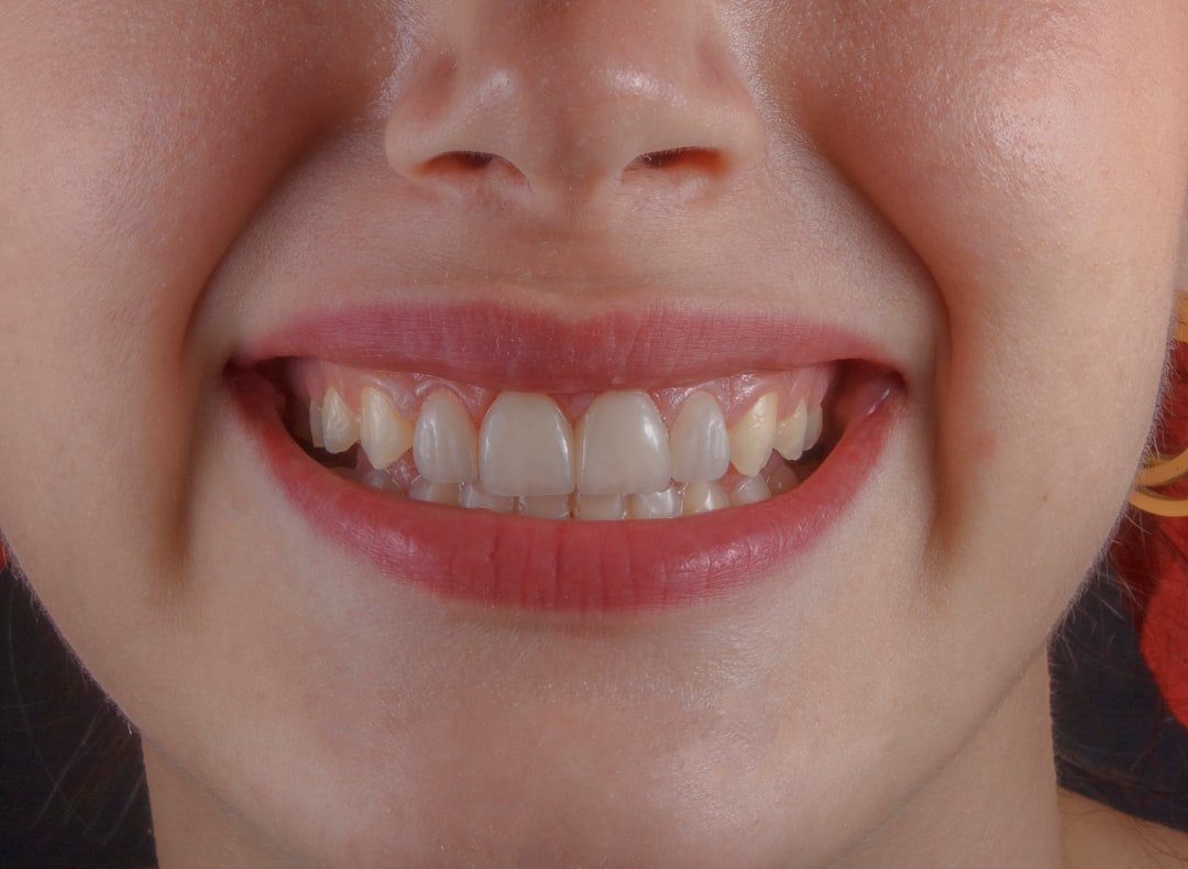 Facetas de resina: antes e depois — o que muda no seu sorriso